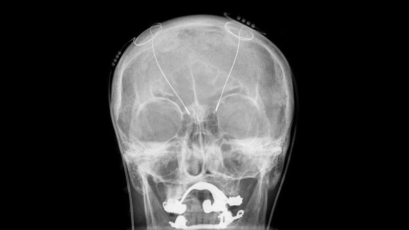 Depressione grave curata con stimolazione cerebrale:prima volta al mondo